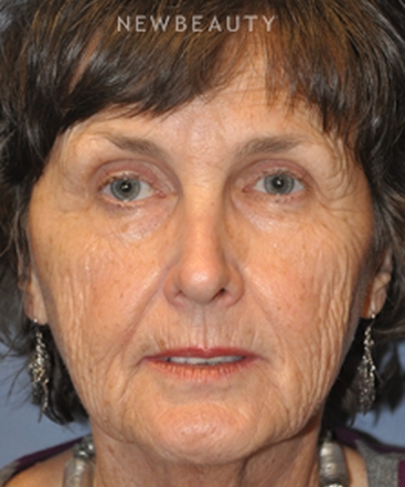 dr-bryan-w-gawley-facelift-b