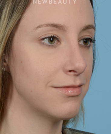 dr-jeffrey-wise-rhinoplasty-b