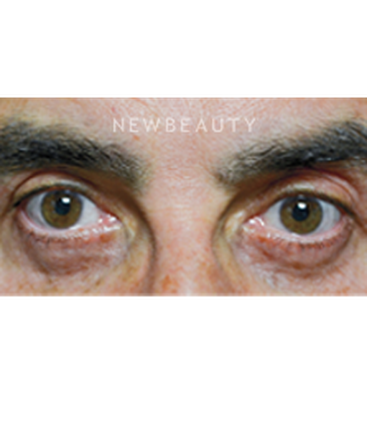 dr-baljeet-purewal-blepharoplasty-b