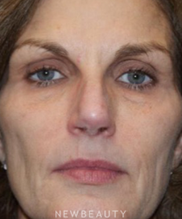 dr-marina-peredo-sculptra-b