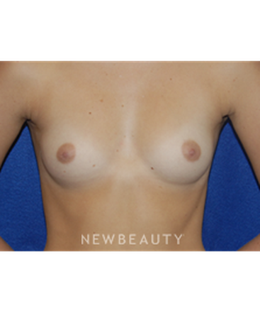 dr-bradley-bengtson-breast-augmentation-b