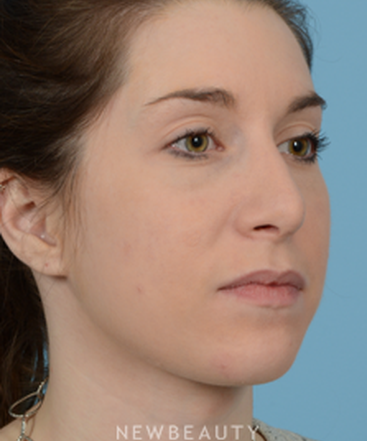 dr-jeffrey-wise-rhinoplasty-b