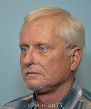 dr-ryan-p-chastant-facelift-b