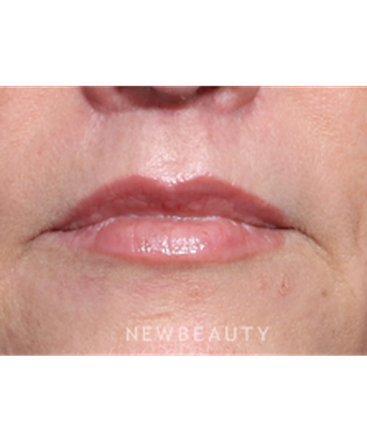 la-jolla-cosmetic-surgery-lip-lift-b