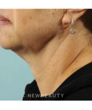 dr-marina-peredo-necklift-b