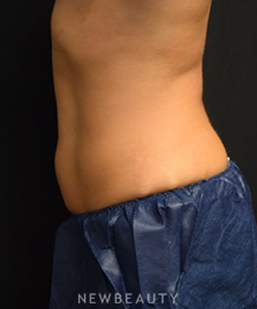 dr-jeffrey-b-wise-coolsculpting-b