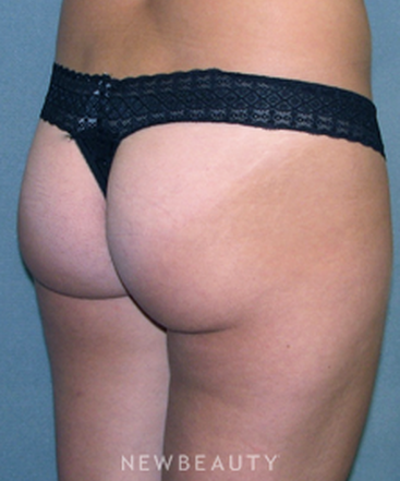 dr-sean-simon-butt-augmentation-b
