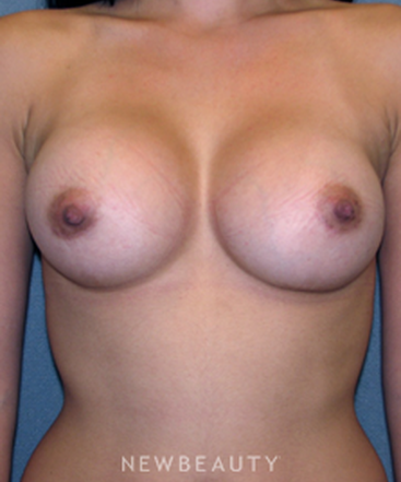 dr-sean-simon-breast-augmentation-b