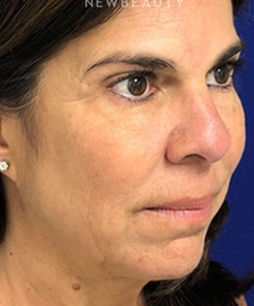 dr-dilip-madnani-facelift-necklift-b