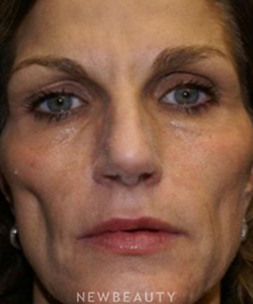 dr-marina-peredo-sculptra-b