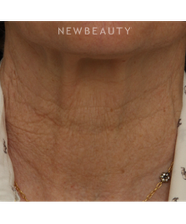drs-jennifer-segal-scott-smith-microneedling-b