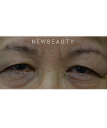 dr-baljeet-k-purewal-blepharoplasty-b