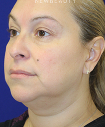 dr-dilip-madnani-facelift-necklift-b