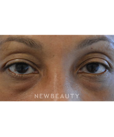 dr-baljeet-purewal-belpharoplasties-b