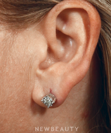 dr-kenneth-beer-ear-repair-b