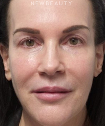 dr-marina-peredo-facelift-b