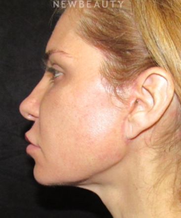 dr-joseph-grzeskiewicz-macs-facelift-b