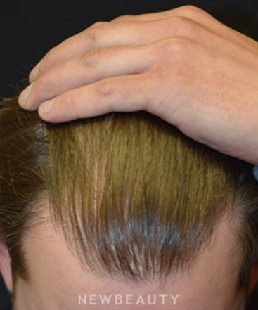dr-jeffrey-b-wise-hair-transplant-b