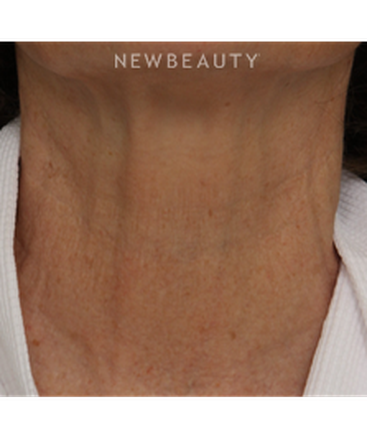 drs-jennifer-segal-scott-smith-microneedling-b