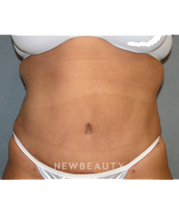 dr-sean-simon-tummy-tuck-lipo-b