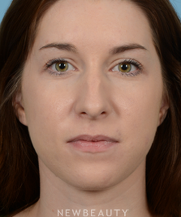 dr-jeffrey-wise-rhinoplasty-b