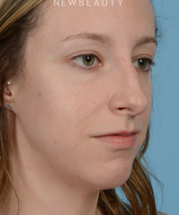 dr-jeffrey-wise-rhinoplasty-b