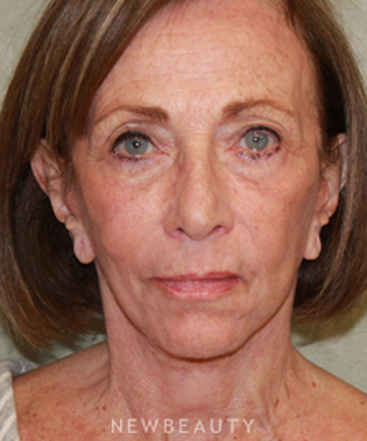 dr-dilip-d-madnani-facelift-necklift-b