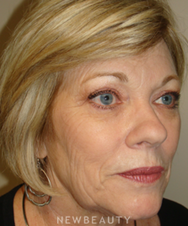 dr-sanjay-grover-facelift-browlift-neck-lift-eyelift-b