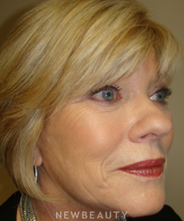 dr-sanjay-grover-facelift-browlift-neck-lift-eyelift-b