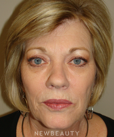 dr-sanjay-grover-facelift-browlift-neck-lift-eyelift-b