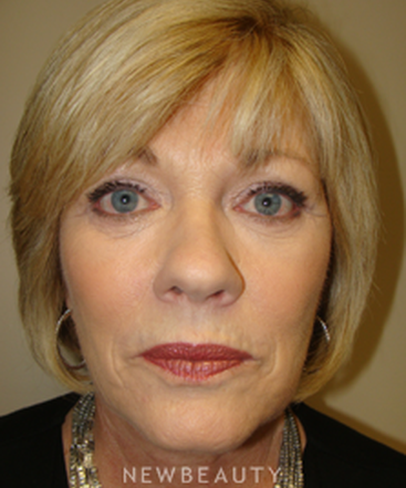 dr-sanjay-grover-facelift-browlift-neck-lift-eyelift-b