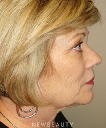 dr-sanjay-grover-facelift-browlift-neck-lift-eyelift-b
