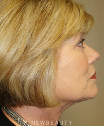 dr-sanjay-grover-facelift-browlift-neck-lift-eyelift-b