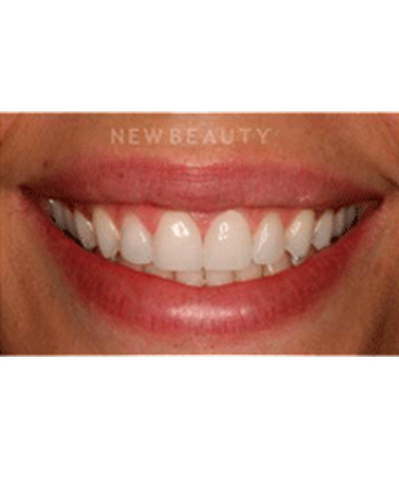 dr-laurence-rifkin-veneers-teeth-whitening-b