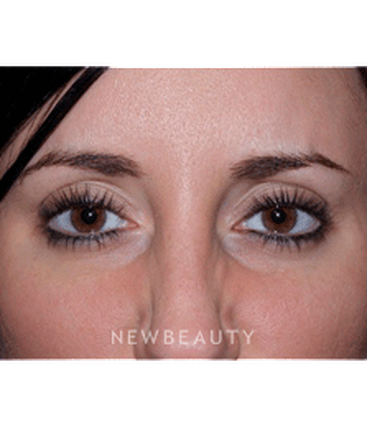 dr-marina-peredo-botox-b
