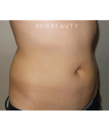 dr-sanjay-grover-coolsculpting-b