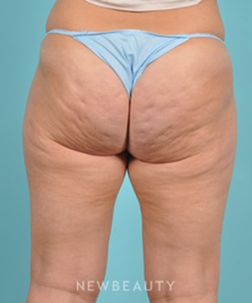 dr-brad-bengtson-cellulite-treatment-b