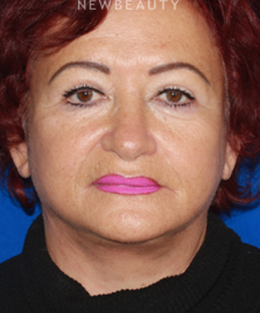 dr-konstantin-vasyukevich-lower-facelift-b