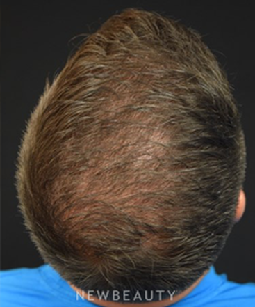 dr-jeffrey-rapaport-hair-transplant-b