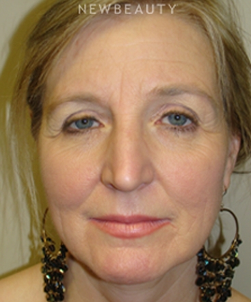 dr-sanjay-grover-blepharoplasty-b