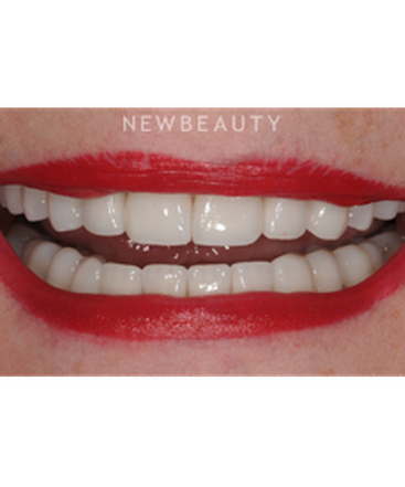 dr-ronald-goldstein-smile-makeover-b
