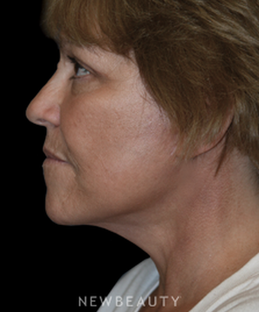 dr-brent-smith-eyelift-facelift-b