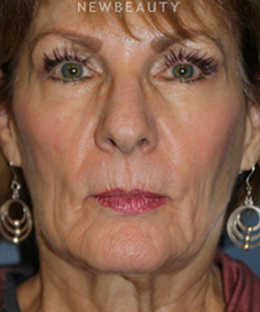 dr-brent-smith-facelift-with-fat-transfer-b
