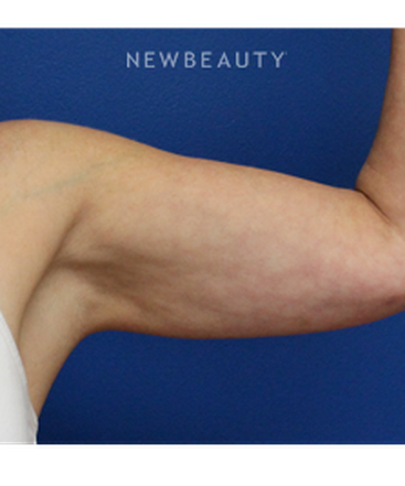 dr-joseph-russo-arm-liposuction-b