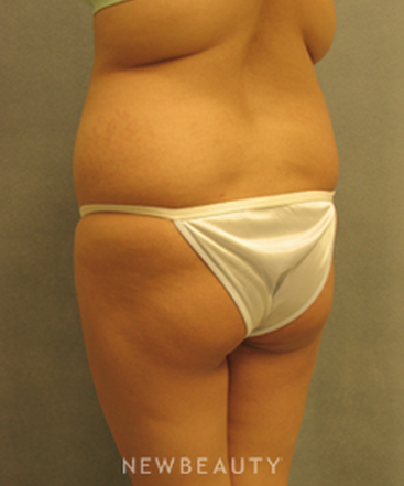 dr-sean-simon-butt-augmentation-b