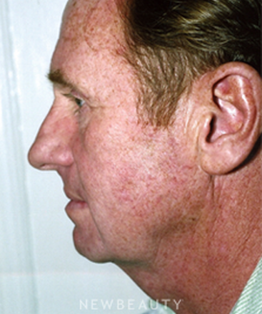 dr-david-rapaport-facelift-b