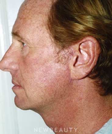 dr-david-rapaport-facelift-b
