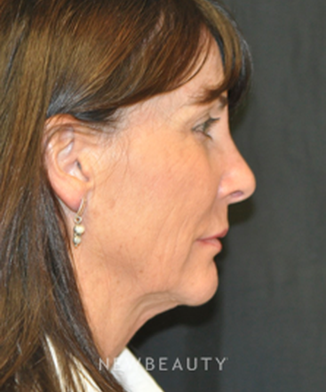 dr-andrew-smith-facelift-b