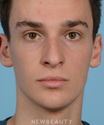 dr-jeffrey-wise-rhinoplasty-b