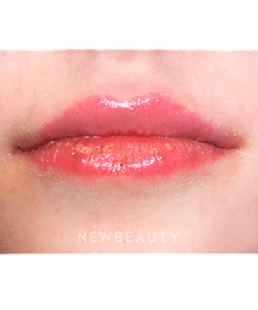 dr-marina-peredo-lip-augmentation-b